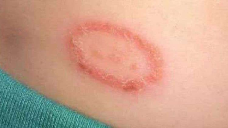 दाद खाज खुजली के कारण / Reasons for herpes itch scabies