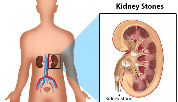 पथरी के लक्षण व घरेलु इलाज / Pathology symptoms and home remedies